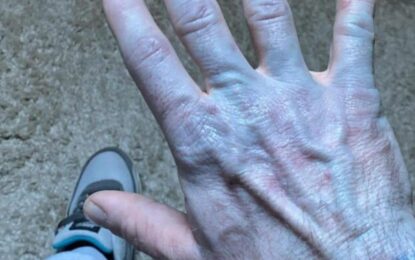 Se despertó con la piel azul y en el hospital descubrió la inesperada causa: «Me sentí avergonzado»