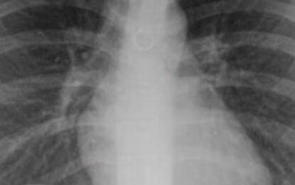 Empezó a toser y un mes después descubrió que tenía un piercing nasal en uno de sus pulmones: «Los médicos estaban impactados»
